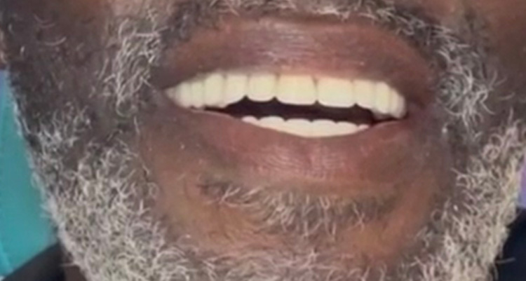After Acrylic Dentures